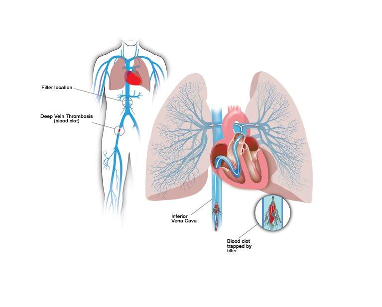 Inferior Vena Cava Filters | Center For Vein Care